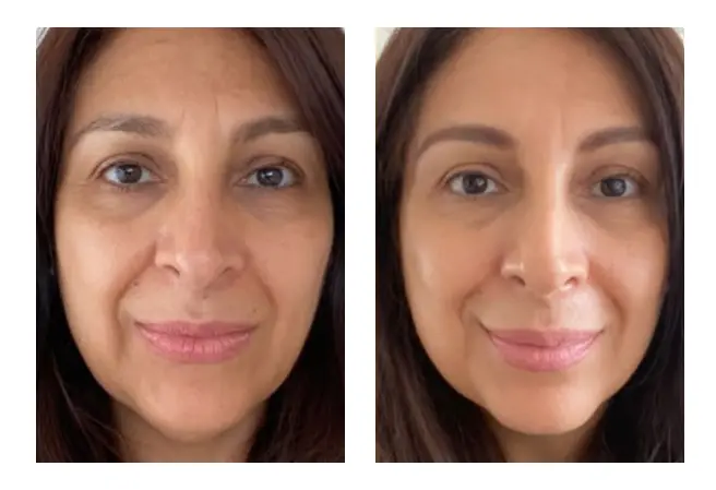 Comparación antes y después de sostener la toma diaria de RENÖVA+